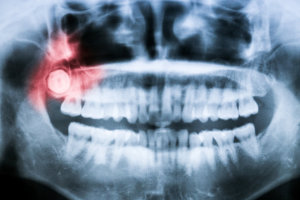Closeup x-ray of impacted wisdom tooth